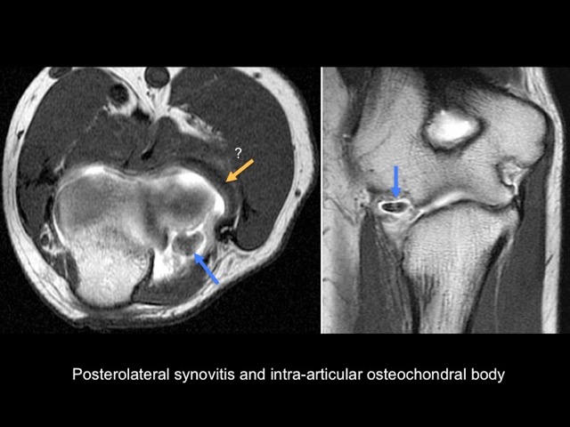 Figure 4 for case annular ligament of radius ( RID2048 )